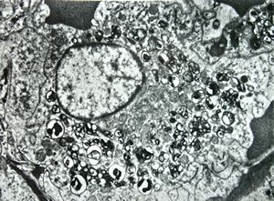 F,68y. | spleen - undefined myelinoid inclusions - clin. susp. leukemia F,68y. | spleen - undefined myelinoid inclusions - clin. susp. leukemia
